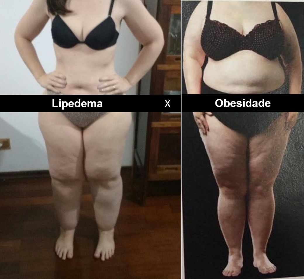 Lipedema X Obesidade